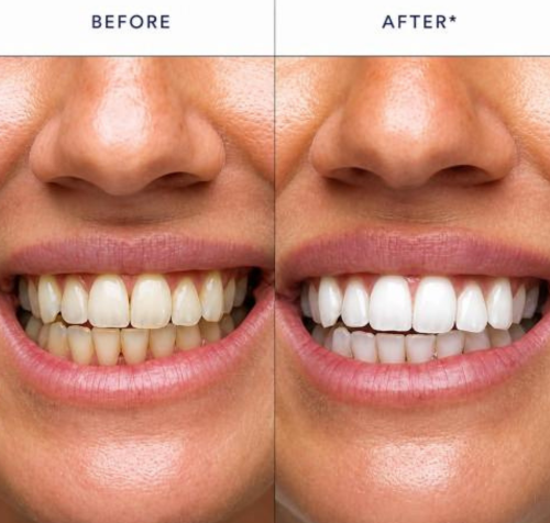 Stain Whitening Mouthwash